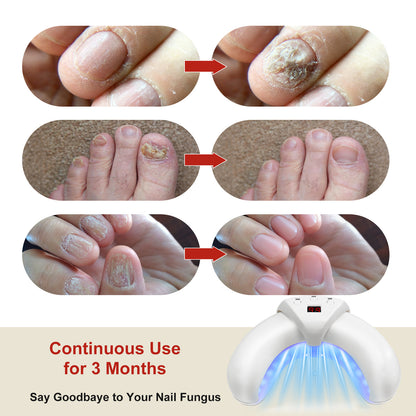 45W 905nm 22-LED Foldable Nail Phototherapy Device