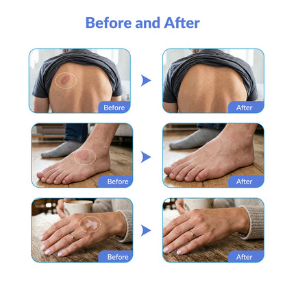 ZJZKTOP Portable 308nm UVB Phototherapy Device | Targeted Handheld Light for Home Use