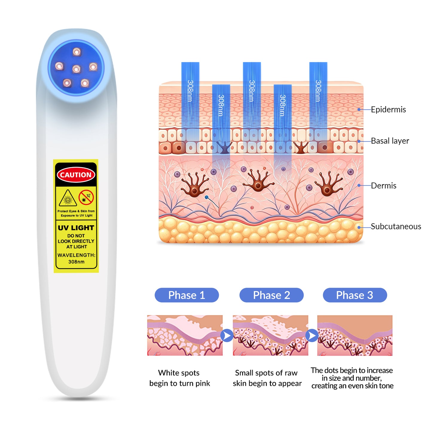 ZJZKTOP Portable 308nm UVB Phototherapy Device | Targeted Handheld Light for Home Use